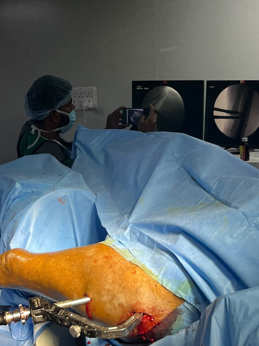 Hip fracture surgery with live C-arm imaging on screen