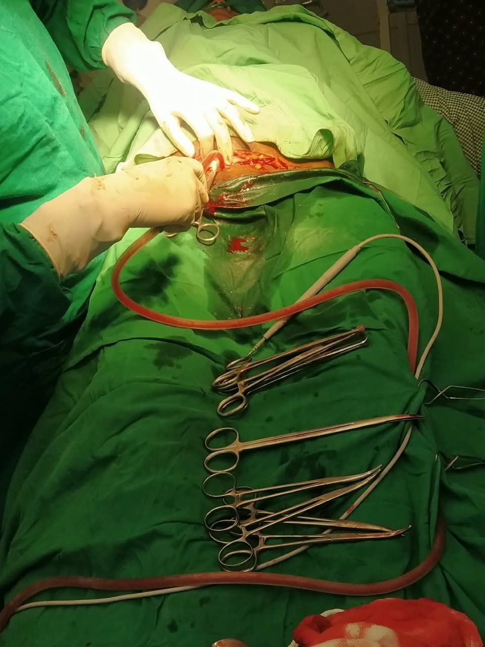 Open surgical field during an abdominal operation
