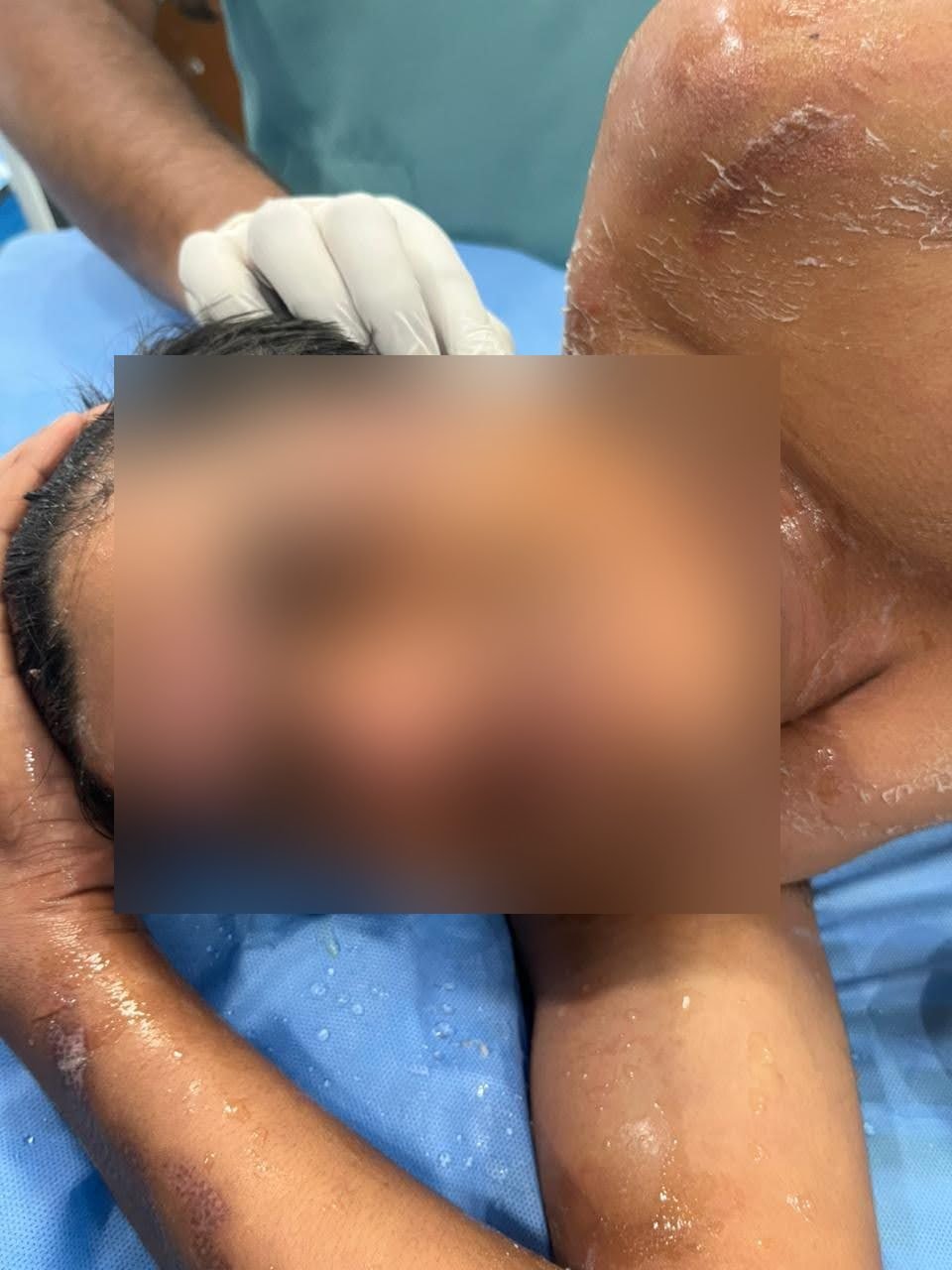 Burn injuries to the shoulder and arm during treatment