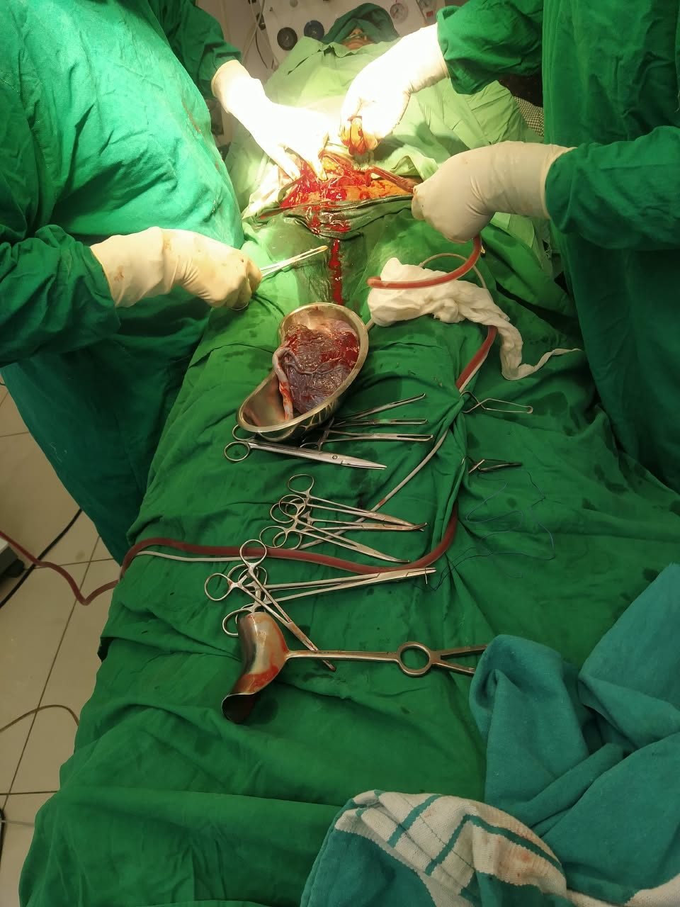 Placenta delivered during a caesarean section
